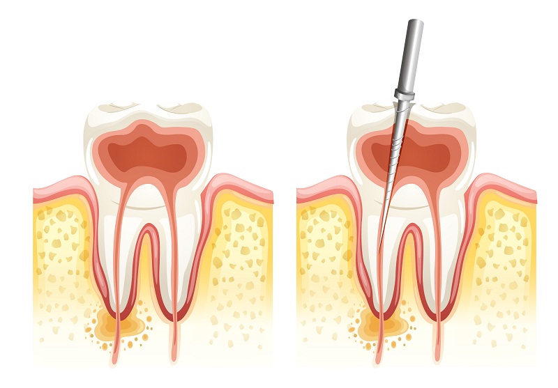 Root Canal Vs. Implant: Which One Is Preferred?