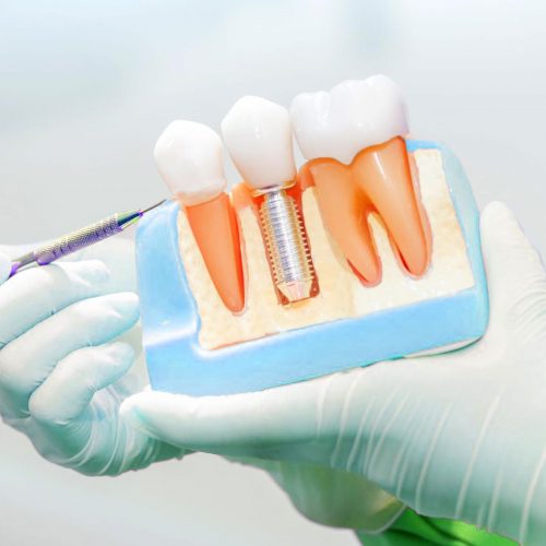 dental-implants-cost-scarborough